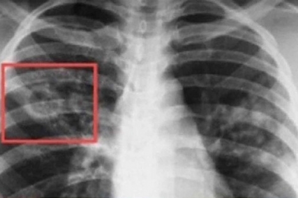 На Рівненщині школяр захворів на туберкульоз
