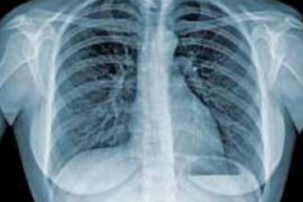 На Рівненщині найвищий показник захворювання на туберкульоз у Костопільському районі