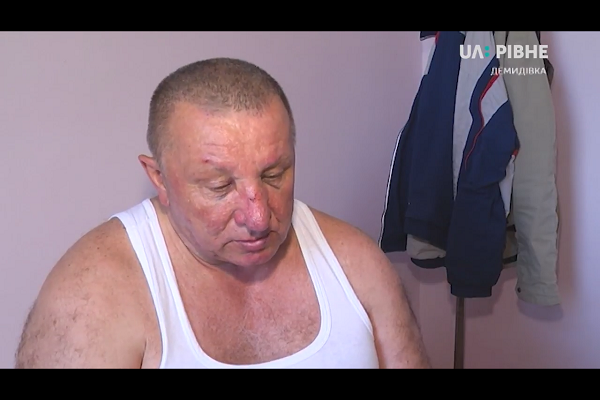 На Рівненщині депутат селищної ради заявляє, що йому розбив обличчя голова районної ради (Відео)