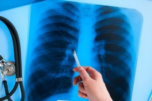 В Україні зареєстрували інноваційні ліки проти туберкульозу